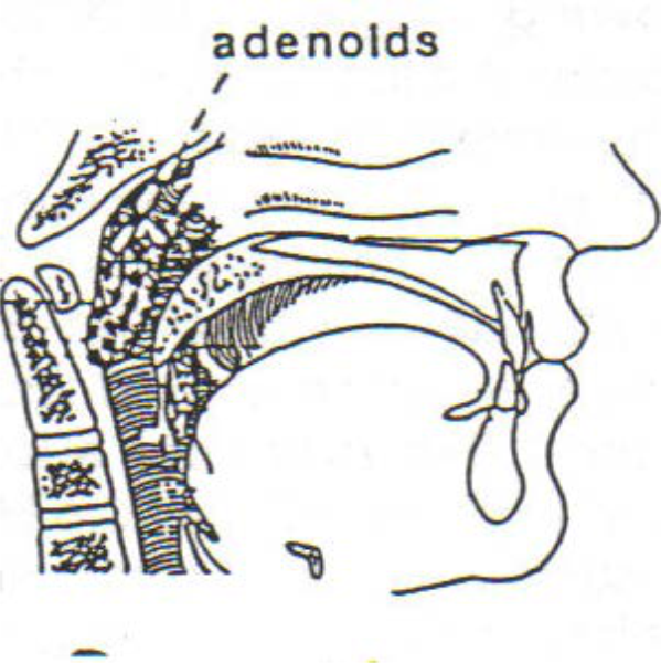 adenoids