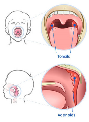 Tonsillectomy And Adenoidectomy Before And After