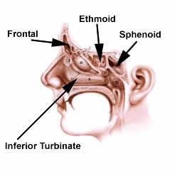 purulent nasal drainage