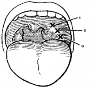 tonsil